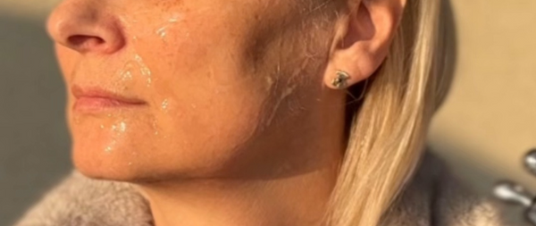 After treatment