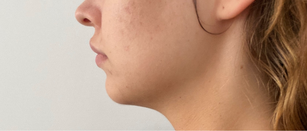 Before treatment