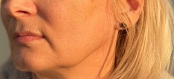 Before treatment